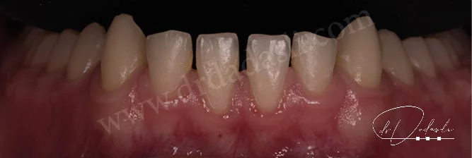 Alt dişler arasında yaygın boşluklar var. Ortodontide bu duruma polidiastema denmektedir.