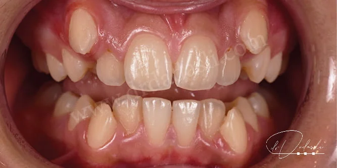 Hem alt çenede hem de üst çenede yer darlığından  dolayı dişlerde ciddi çapraşıklık oluşmuş durumda.