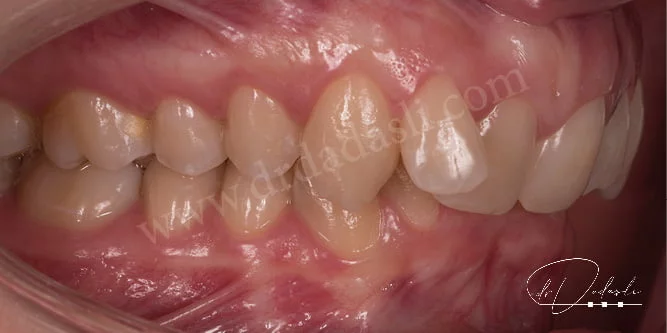 Sınıf iki maloklüzyon. Alt çene üst çeneye göre geride konumlanmıştır. Ortodontik tedavi