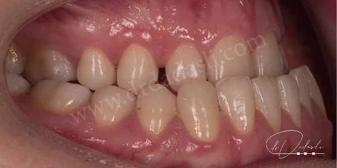 Sınıf üç maloklüzyon. Alt dişler üst dişlerin önünde konumlanmıştır.