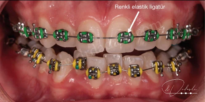 Ortodotnik tedavide kullanılan geleneksel metal braketler ve braketlere bağlanan renkli elastik ligatürleri görmekteyiz.
