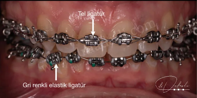 Ortodotnik tedavide kullanılan geleneksel metal braketler ve braketlere bağlanan tel ve elastik ligatürleri görmekteyiz. Ortodontik tedavi
