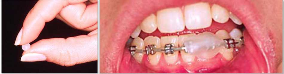 Sol taraftaki görselde ortodontik hasta mumu, sağ taraftaki görselde ise hasta mumunun uygulanışı gösterilmektedir.