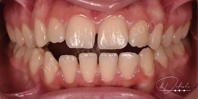 Ağız kapalıyken arka dişler temas etmesine rağmen ön dişler kapanmamaktadır. 