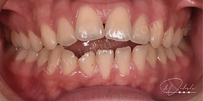 Ağız kapalıyken arka dişler temas etmesine rağmen ön dişler kapanmamaktadır. 