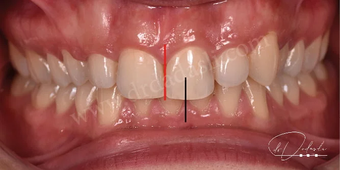 Üst iki orta keser dişin ortası ile alt iki orta keser dişin ortasının üst üste gelmemesine ortodontide orta hat kayması denir.