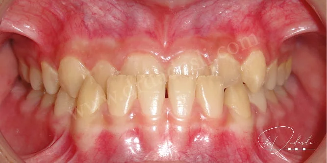 Alt dişler üst dişlerin önünde konumlanmıştır. Ön çapraz kapanış vardır. 