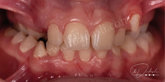 Normalde üst çene alt çeneyi kutu kapağı şeklinde kapatması lazım. Görselde ise arka tarafta üst çenenin dar olduğu görünmekte.