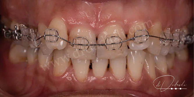 Daha estetik braketler olan safir braketler ve üzerine takılan tel görmekteyiz.