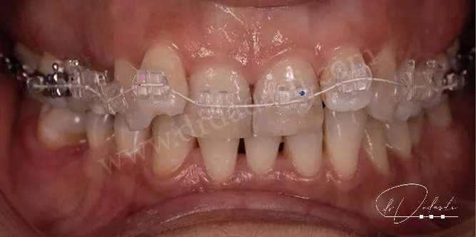 Daha estetik braketler olan safir braketler ve üzerine takılan estetik kaplamalı tel görmekteyiz.