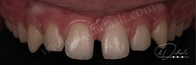 Üst dişler arasında yaygın boşluklar var. Ortodontide bu duruma polidiastema denmektedir.