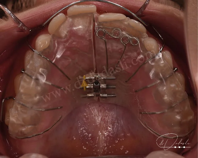 Çocuklarda üst çene genişletmesi için kullanılan Hawley apareyi.