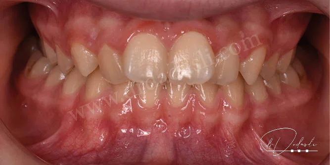 Üst çene genişletme apareyi ağıza yapıştırılmış, henüz vidası çevrilmeye başlanmamıştır.