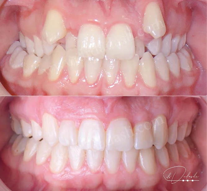 Üstteki fotoğrafta hastanın ortodontik tedaviye başlamadan önceki durumu görülüyor. Üst köpek dişleri yer bulamamış ve üst çenede ciddi darlık var. Alttaki fotoğrafta ise üst çene genişletilip dişler ortodontik tedavi ile düzeltilmiştir.