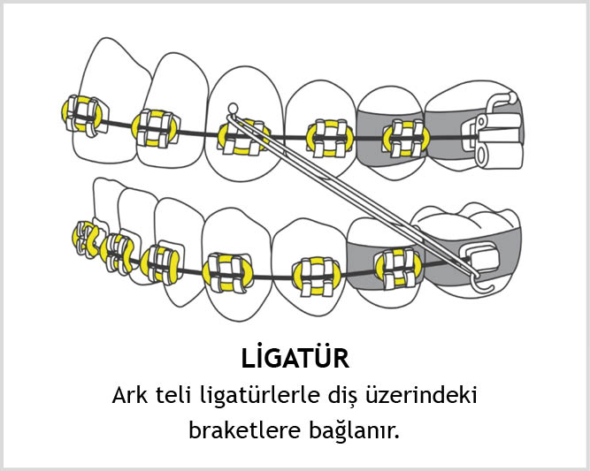 Ark teli ligatürlerle diş üzerindeki braketlere bağlanır.