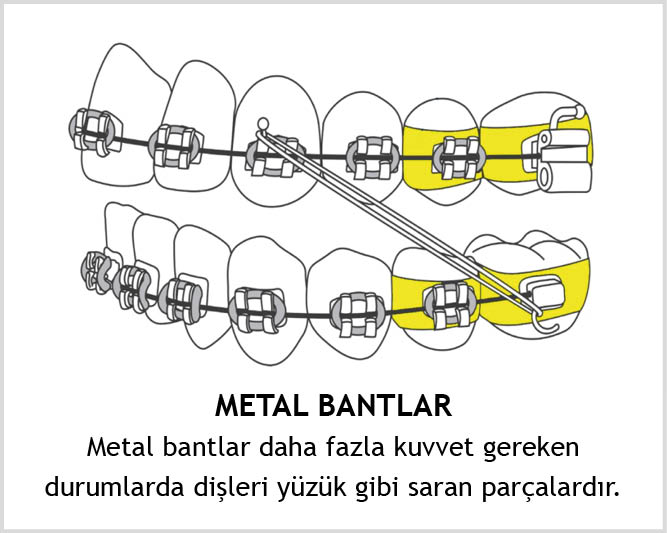 Metal bantlar daha fazla kuvvet gereken durumlarda dişleri yüzük gibi saran parçalardır.