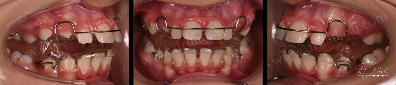 Geride olan alt çeneyi öne almak için kullanılan hareketli fonksiyonel aparey örneği. Soldaki fotoğraf apareyin ağız içi sağ taraftan, ortadaki fotoğraf ağız içi önden, sağdaki fotoğraf ise ağız içi soldan görünümünü temsil etmektedir. Twin Block Apareyi